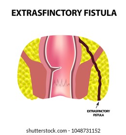 Types of fistulas of the rectum. Paraproctitis. Anus. Abscess of the rectum. Infographics. Vector illustration on isolated background
