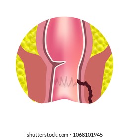 Types of fistulas of the rectum. Paraproctitis. Anus. Abscess of the rectum. Infographics. Vector illustration on isolated background
