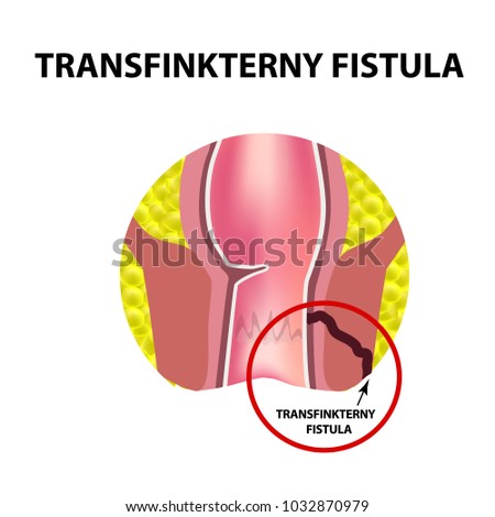 Types of fistulas of the rectum. Paraproctitis. Anus. Abscess of the rectum. Infographics. Vector illustration on isolated background