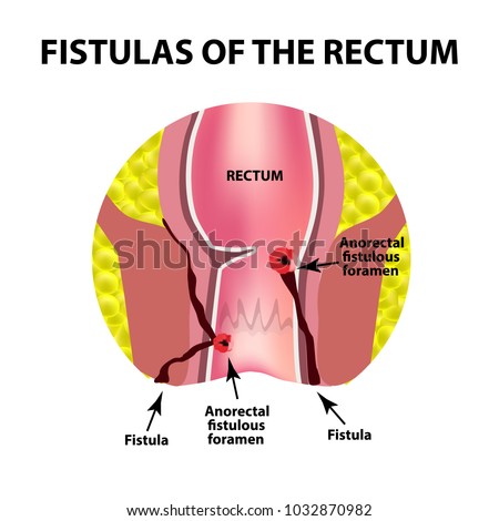 Types of fistulas of the rectum. Paraproctitis. Anus. Abscess of the rectum. Infographics. Vector illustration on isolated background