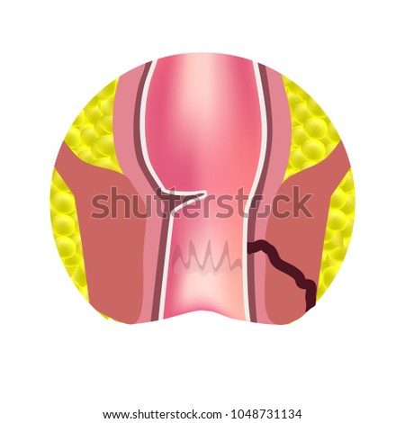 Types of fistulas of the rectum. Paraproctitis. Anus. Abscess of the rectum. Infographics. Vector illustration on isolated background