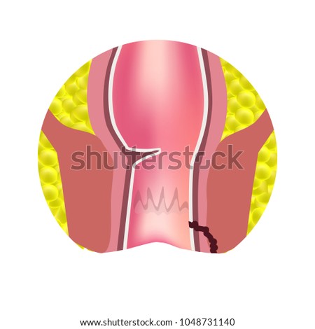 Types of fistulas of the rectum. Paraproctitis. Anus. Abscess of the rectum. Infographics. Vector illustration on isolated background