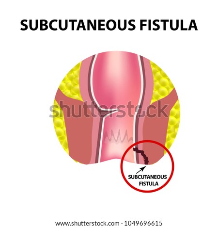 Types of fistulas of the rectum. Paraproctitis. Anus. Abscess of the rectum. Infographics. Vector illustration on isolated background