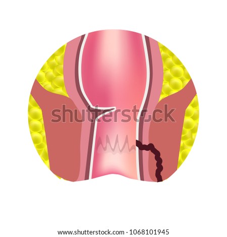 Types of fistulas of the rectum. Paraproctitis. Anus. Abscess of the rectum. Infographics. Vector illustration on isolated background