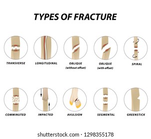 Types Fracture Fracture Bone Set Infographics Stock Vector (Royalty ...