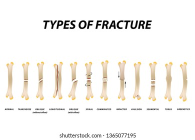 Types Fracture Fracture Bone Set Infographics Stock Vector (Royalty ...