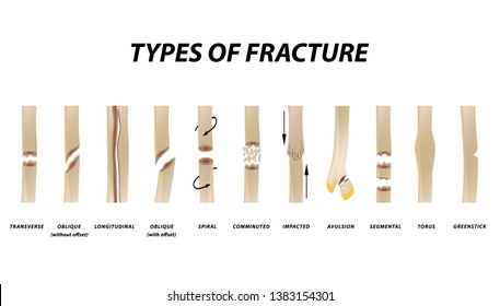 Types of fracture. Fracture bone set. Infographics. Vector illustration on isolated background.