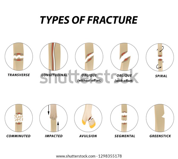 Types Fracture Fracture Bone Set Infographics Stock Vector (Royalty ...