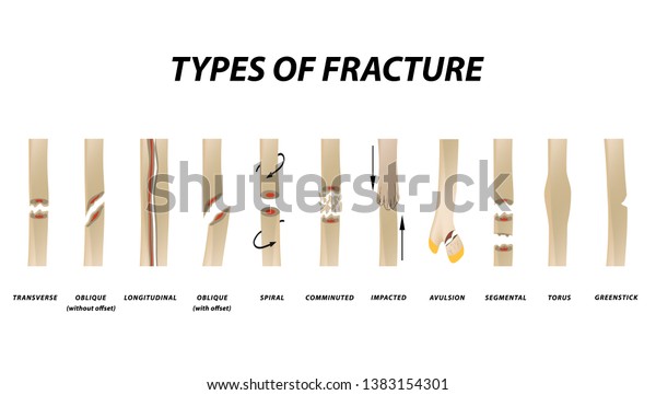 types of bone fracture types of bone fracture