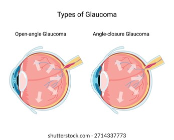 Tipos de glaucoma ocular. Anatomía del ojo humano. Estructura ocular, presión ocular. Tratamiento. Diagrama para la educación y el uso médico.  Ilustración vectorial

