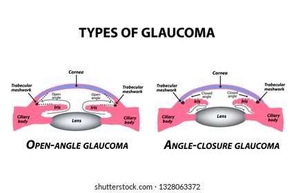 Types of glaucoma. Open-angle and angle-closure glaucoma. The anatomical structure of the eye. Infographics. Vector illustration on isolated background.