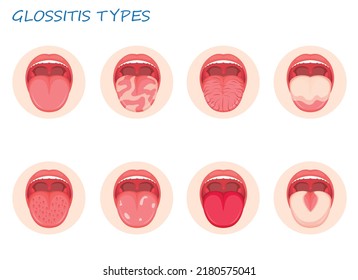 Types glossitis. Candidiasis of the tongue, thrush. Inflammation of the tongue. Infographics. Vector illustration on isolated background