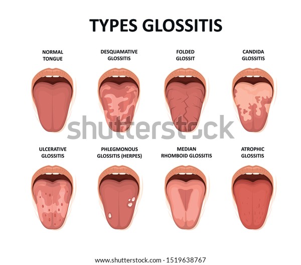 舌炎の型 舌の病気のイラスト のベクター画像素材 ロイヤリティフリー