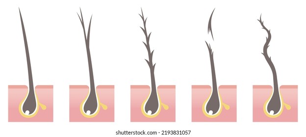 Types Of Hair Problems Cross Section. Normal, Split Ends, Damaged, Break Off, Frizz. Vector Illustration Isolated On White Background.