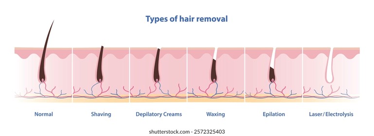 Types of hair removal vector illustration on white background. Methods of remove unwanted hair include shaving, depilatory creams, waxing, epilation, laser and electrolysis. Skin care, beauty concept.