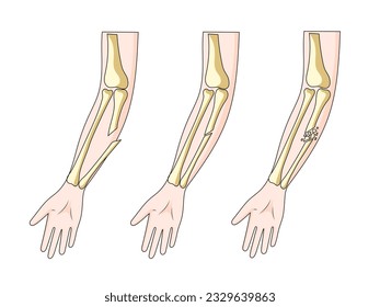 Types of hand bone fractures diagram schematic vector illustration. Medical science educational illustration