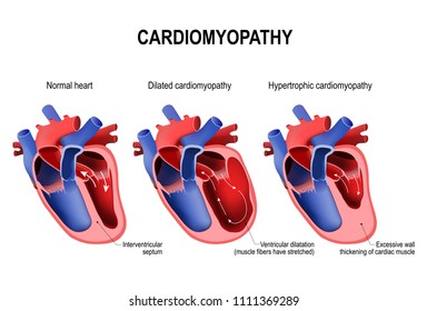 Types of heart diseases: hypertrophic cardiomyopathy and dilated cardiomyopathy. healthy heart and heart with Pathology. vector illustration for medical use