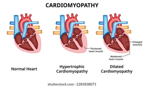 Tipos de enfermedades cardíacas: cardiomiopatía hipertrófica y cardiomiopatía dilatada - Ilustración médica vectorial