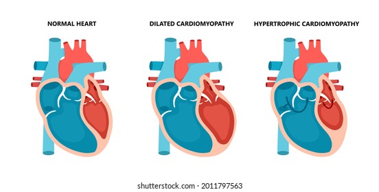 Types Heart Diseases Normal Hypertrophic Dilated Stock Vector (Royalty ...