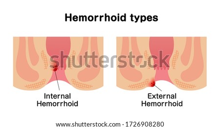 Types of Hemorrhoid flat vector illustration