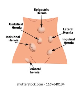 Hernia Chart