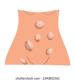 Types of hernia. Epigastric, Lateral, Umbilical, Inguinal, femoral, incisional hernia. intestinal hernia. Infographics. Vector illustration on isolated background.