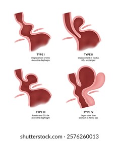 Types of the Hiatal Hernia and Symptoms