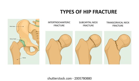 Tipos de fractura de cadera. Fractura del cuello femoral. Ilustración vectorial médica