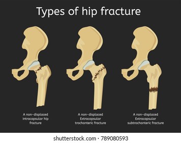 Types Of Hip Fracture. Non-displaced Intracapsular, Extracapsular Trochanteric And Subtrochanteric Fractures. Vector Illustration.