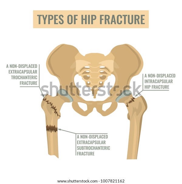 Types Hip Fracture Nondisplaced Intracapsular Extracapsular庫存向量圖 免版稅 1007821162