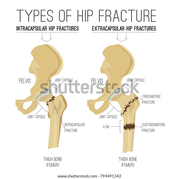 Types Hip Fracture Nondisplaced Intracapsular Extracapsular Stock ...