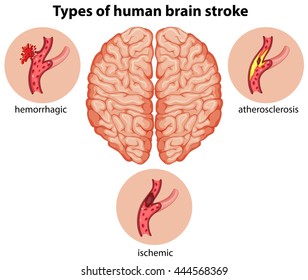 Types Of Human Brain Stroke Illustration