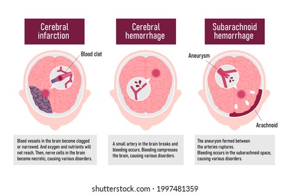 Types Of Human Brain Stroke Vector Illustration