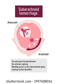 Types of human brain stroke vector illustration. Subarachnoid hemorrhage