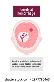 Types of human brain stroke vector illustration | Cerebral hemorrhage