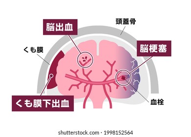 Types of human brain stroke vector illustration. Translation: Cerebral hemorrhage, Subarachnoid  hemorrhage, Cerebral infarction, Arachnoid, Skull, Blood clot.