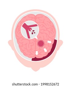 Types of human brain stroke vector illustration | Subarachnoid hemorrhage