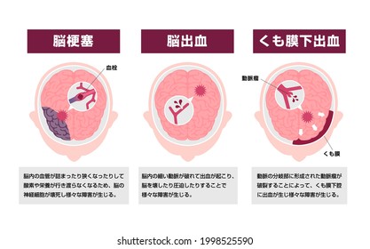 Types of human brain stroke vector illustration. Translation: Cerebral infarction, Cerebral hemorrhage, Subarachnoid  hemorrhage, Blood clot, Aneurysm, Arachnoid.