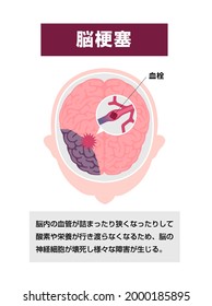 Types of human brain stroke vector illustration | Cerebral infarction. Translation: Cerebral infarction, Blood clot.