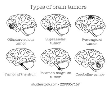 Types of human brain tumors. One line drawing for different uses. Vector illustration.