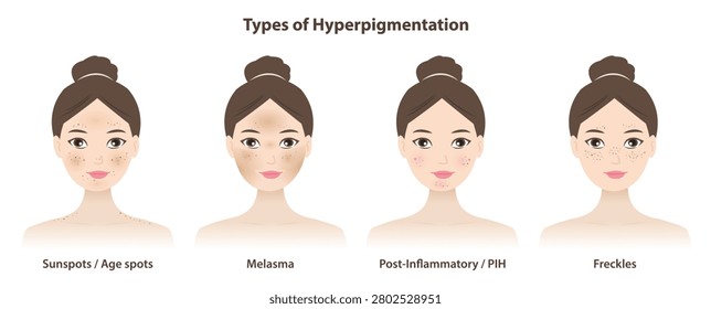 Types of hyperpigmentation skin on woman face vector illustration. Sunspots, Age spots, Melasma, Post inflammatory hyperpigmentation (PIH) and Freckles occurs when the body overproduces melanin.