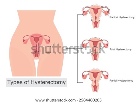 Types of Hysterectomies. Hysterectomy is surgery to remove the uterus.There are several types of hysterectomies:Total hysterectomy, Partial hysterectomy and Radical hysterectomy,vector illustration.