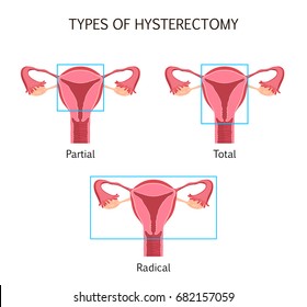 Types of Hysterectomy. Surgical removal of the uterus. Vector illustration design