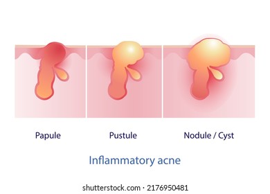 Types Of Inflammatory Acne Vector On White Background. Papule, Pustule, Nodule And Cyst. Skin Care And Beauty Concept Illustration.