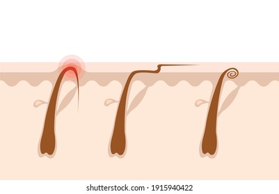 Types of ingrown hairs flat illustration. Cross section of the human skin with hair follicles. Hair removal concept.Can be used for topics like shaving, depilation, cosmetology