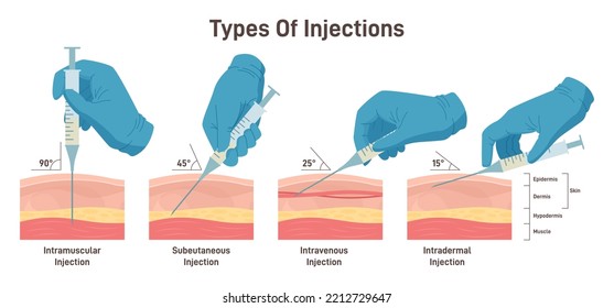 Types of injections. Guide to injecting medication into skin. Doctor holding syringes at different angles. Intramuscular, intradermal, intravenous and subcutaneous injection. Flat vector illustration