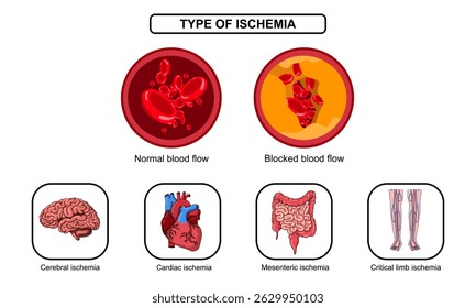 Ischämiearten, myokardiale und mesenterische Ischämie, Hirnschlag und periphere arterielle Verschlusskrankheit. Blutgefäßverstopfung, Plaque, Infarkt und Thrombose. Vektorgrafik für Mediziner