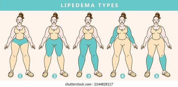 The types of lipedema. Healthcare problems. Medical infographic illustration. Vector illustration. svg