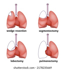 Types of lung resection. Removal of an organ or its individual parts in case of cancer. Medical poster. Vector illustration.