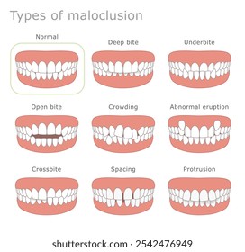 Tipos de ilustração dentária de má oclusão. A ilustração mostra diferentes tipos de má oclusão humana.